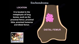 ALHE Angiolymphoid Hyperplasia with Eosinophilia 5Minute Pathology Pearls [upl. by Eppie]