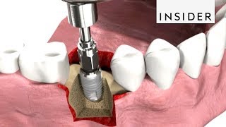 How Dentists Insert Dental Implants [upl. by Enicul]