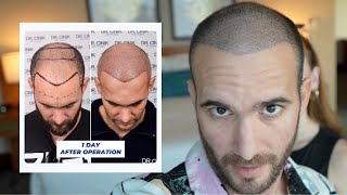 My Hair Transplant Journey Days 114 [upl. by Einalem]