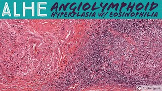 Vascular tumors  Angiosarcoma  Definition Epidemiology Pathology Diagnosis and treatment [upl. by Aisatna]