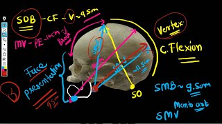 Fetal Skull Diameters  Diameters of engagement [upl. by O'Toole358]