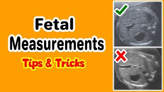 Fetal Measurements Tips and Tricks [upl. by Ellekcim100]