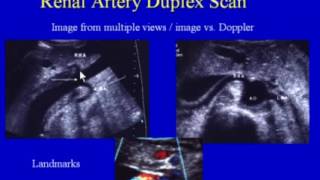 Renal Artery Duplex Scan [upl. by Naleek]