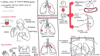 Lung Cancer  Overview [upl. by Bernardi411]