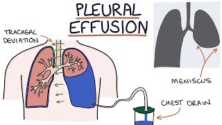 Understanding Pleural Effusions [upl. by Aidua]