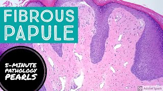 Fibrous Papule Angiofibroma 5Minute Pathology Pearls [upl. by Dora]