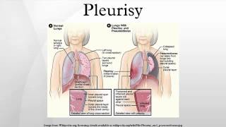 Pleurisy [upl. by Adhamh]