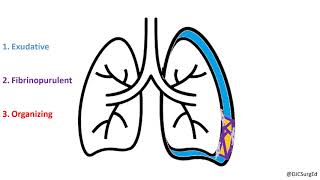 Empyema and Pleural Effusions [upl. by Calley868]