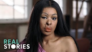 ACID ATTACK My Story Crime Documentary  Real Stories [upl. by Zendah]