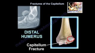 Fracture Of The Capitellum  Everything You Need To Know  Dr Nabil Ebraheim [upl. by Mendes]