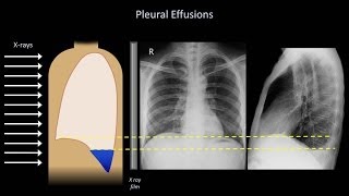 What causes shifting chest pain Can gas amp bloating lead to it  Dr Suresh G [upl. by Hsu458]