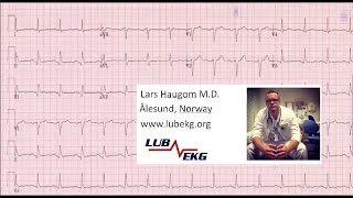 Hvordan lese EKG for turnusleger Norwegian [upl. by Eiramasil]