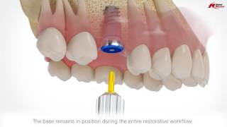 On1 restorative concept  Nobel Biocare [upl. by Tesler698]